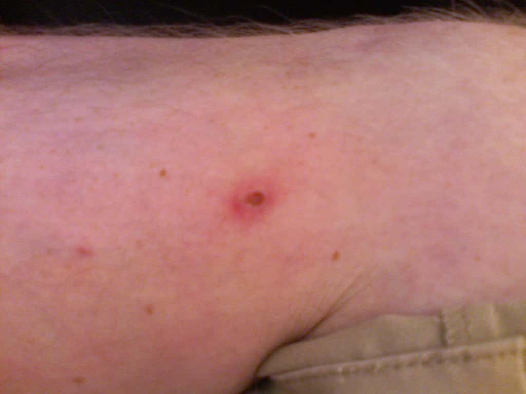 Tick bite on human skin